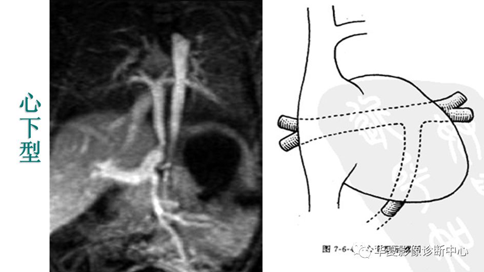 影像PPT - 弯刀综合征-37