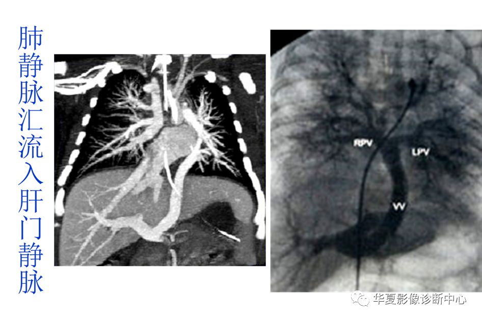 影像PPT - 弯刀综合征-38
