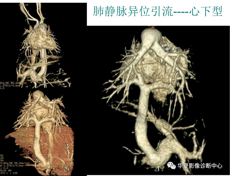 影像PPT - 弯刀综合征-39