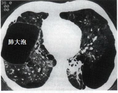 影像PPT - 这竟然不是简单的“肺大泡”,可能是“囊性肺癌”!-3 影像PPT - 这竟然不是简单的“肺大泡”,可能是“囊性肺癌”!-3