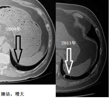 影像PPT - 这竟然不是简单的“肺大泡”,可能是“囊性肺癌”!-10 影像PPT - 这竟然不是简单的“肺大泡”,可能是“囊性肺癌”!-10