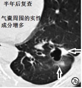 影像PPT - 这竟然不是简单的“肺大泡”,可能是“囊性肺癌”!-13 影像PPT - 这竟然不是简单的“肺大泡”,可能是“囊性肺癌”!-13
