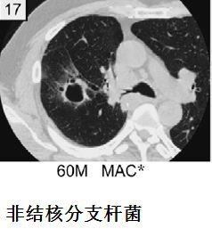 影像PPT - 这竟然不是简单的“肺大泡”,可能是“囊性肺癌”!-21 影像PPT - 这竟然不是简单的“肺大泡”,可能是“囊性肺癌”!-21