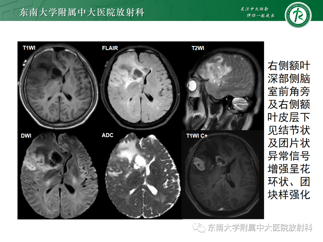 影像PPT - 【PPT】胶质母细胞瘤-4