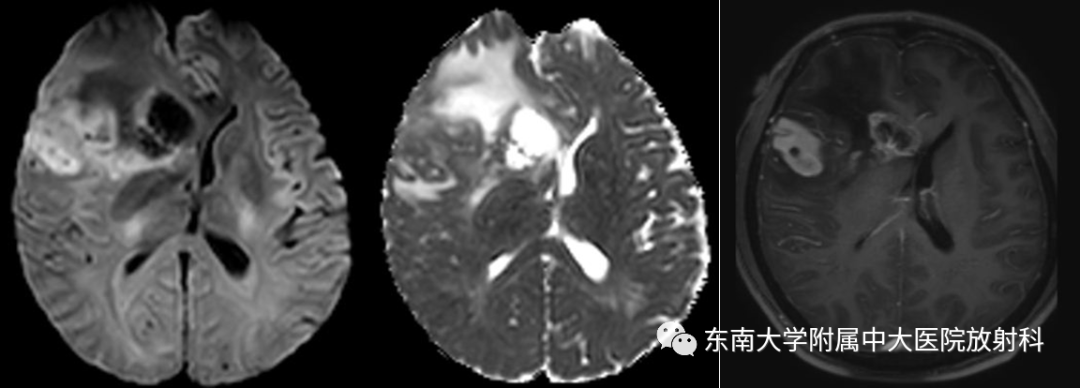 影像PPT - 【PPT】胶质母细胞瘤-2