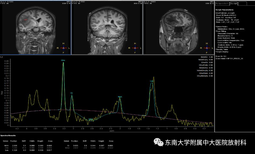 影像PPT - 【PPT】胶质母细胞瘤-3