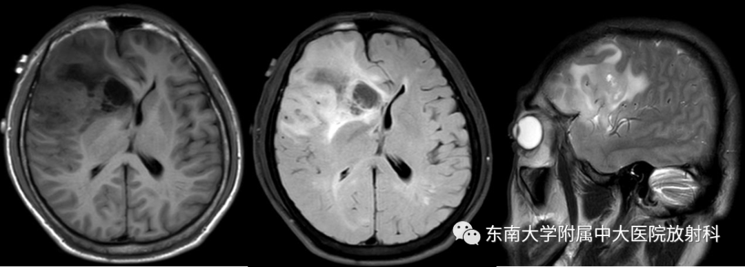 影像PPT - 【PPT】胶质母细胞瘤-1