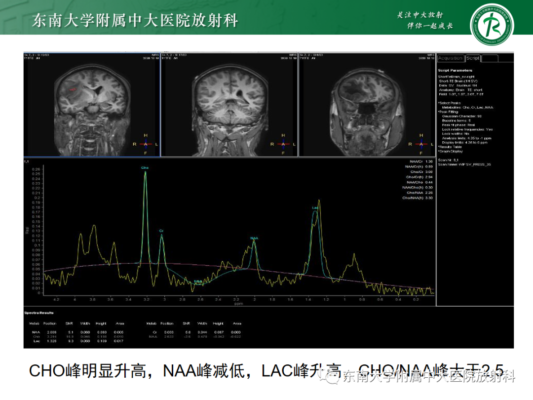 影像PPT - 【PPT】胶质母细胞瘤-5
