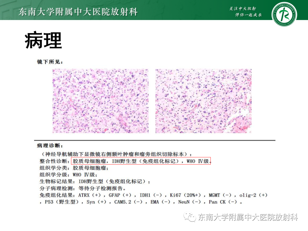 影像PPT - 【PPT】胶质母细胞瘤-6