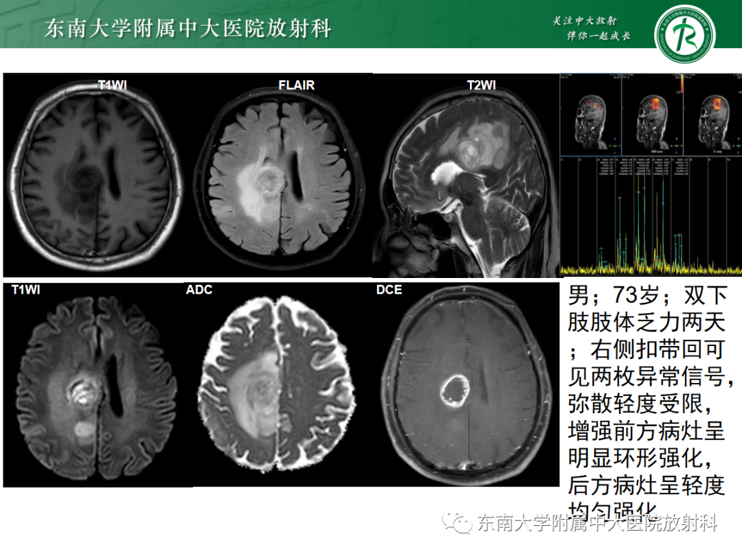 影像PPT - 【PPT】胶质母细胞瘤-16