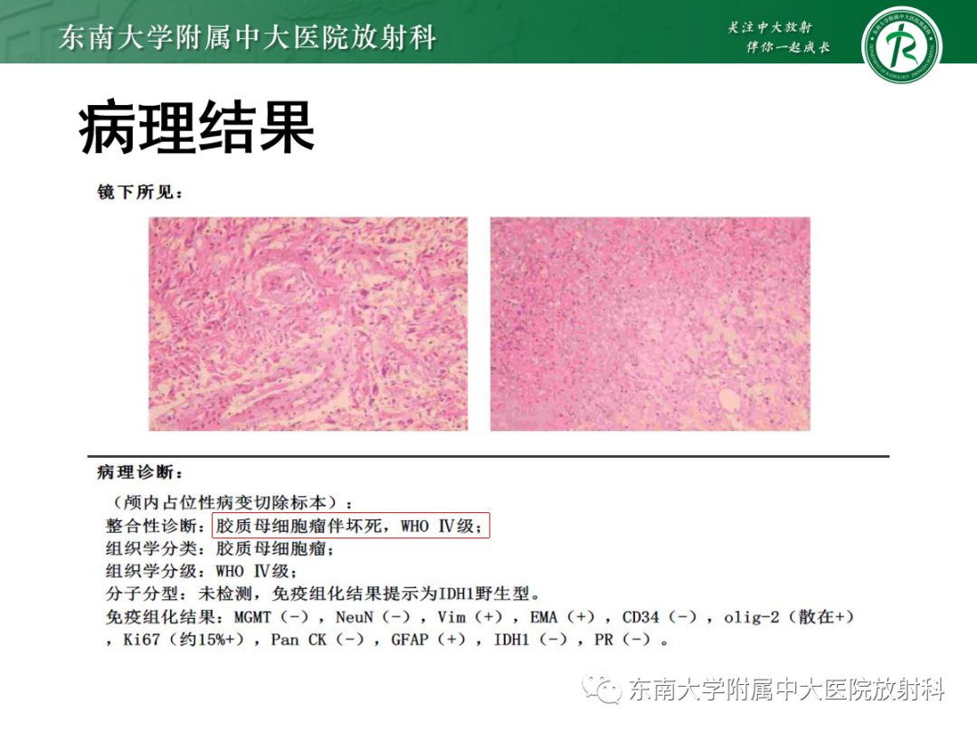 影像PPT - 【PPT】胶质母细胞瘤-17