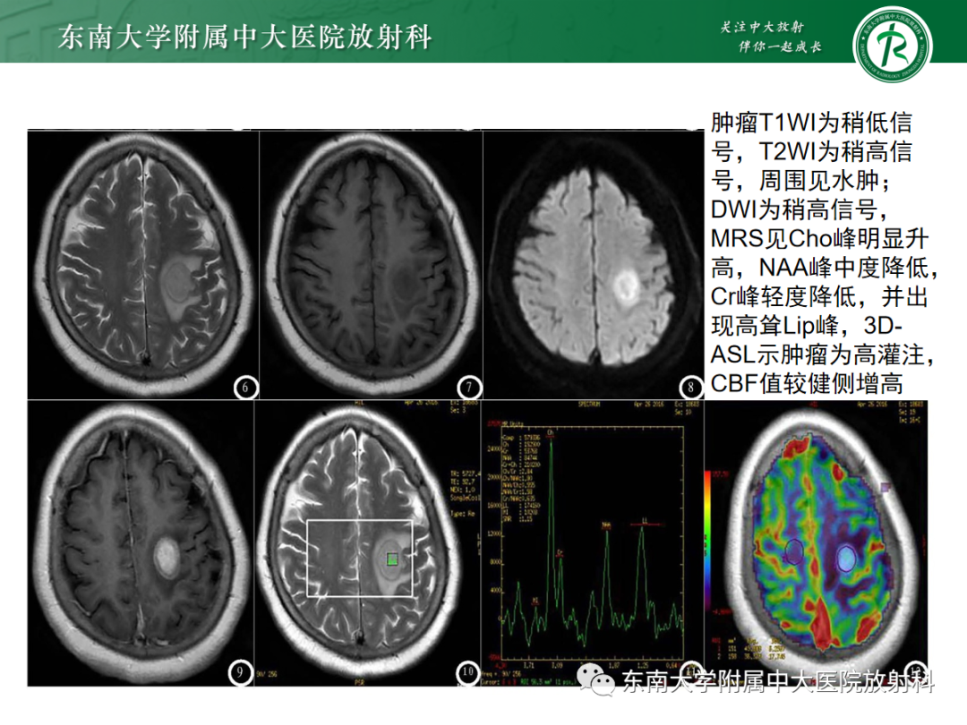 影像PPT - 【PPT】胶质母细胞瘤-18
