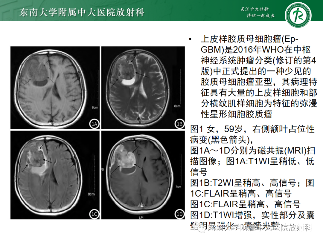 影像PPT - 【PPT】胶质母细胞瘤-20