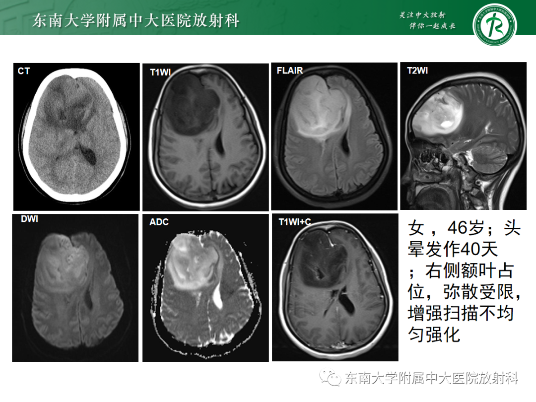 影像PPT - 【PPT】胶质母细胞瘤-23