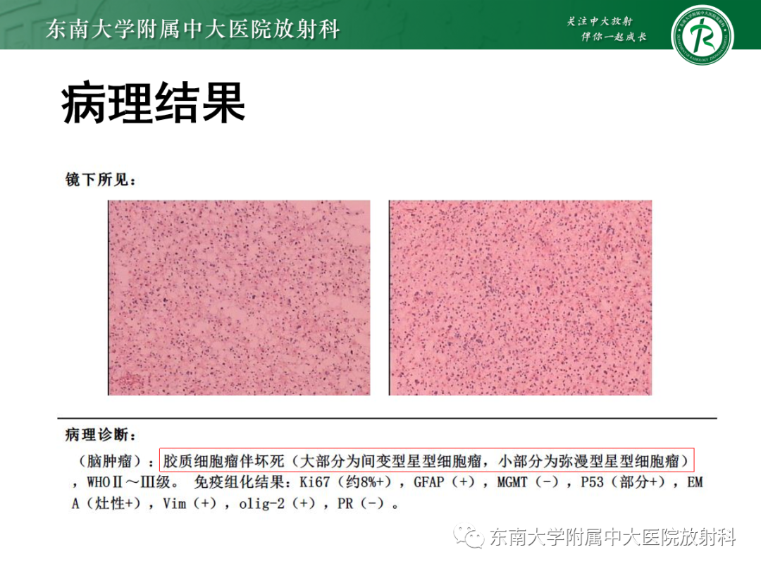 影像PPT - 【PPT】胶质母细胞瘤-24