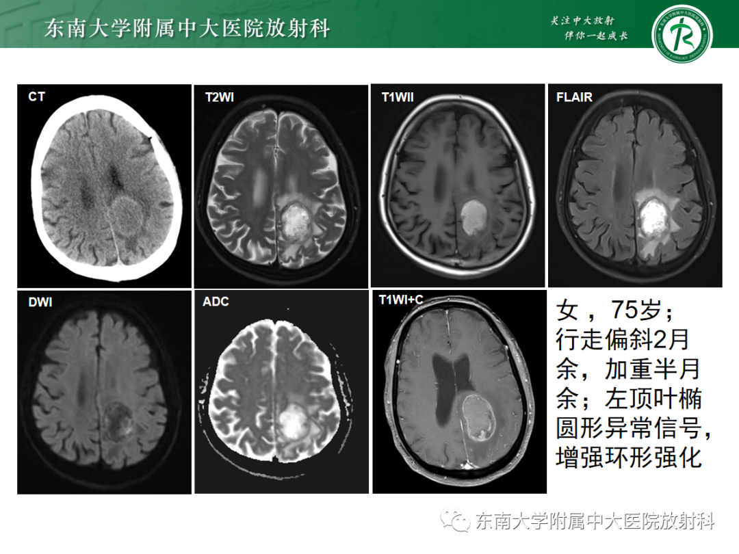 影像PPT - 【PPT】胶质母细胞瘤-26