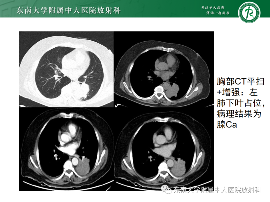 影像PPT - 【PPT】胶质母细胞瘤-27