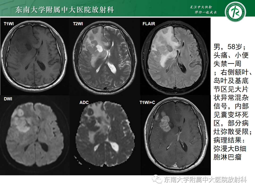 影像PPT - 【PPT】胶质母细胞瘤-29
