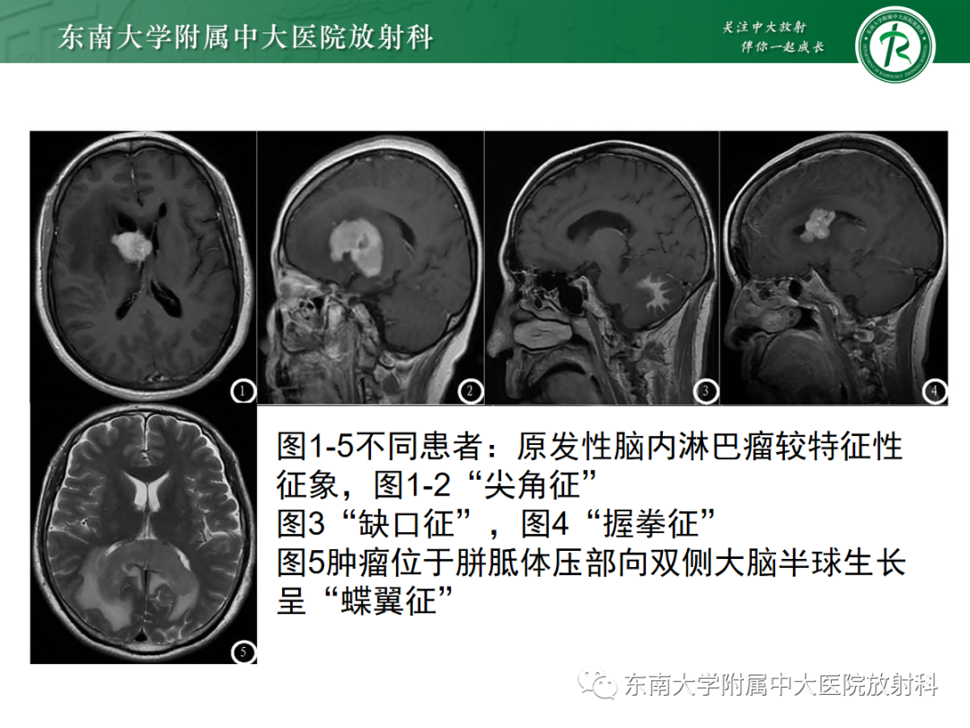 影像PPT - 【PPT】胶质母细胞瘤-30