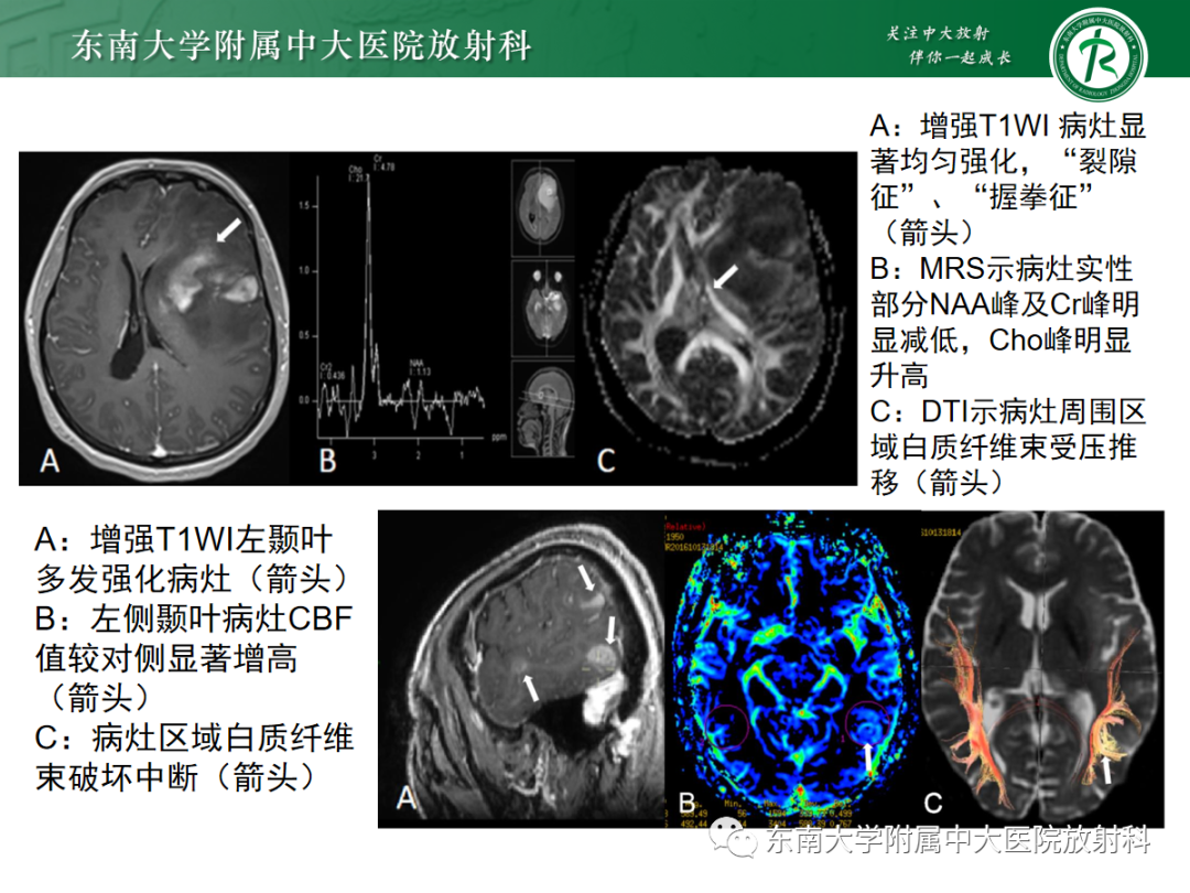 影像PPT - 【PPT】胶质母细胞瘤-31