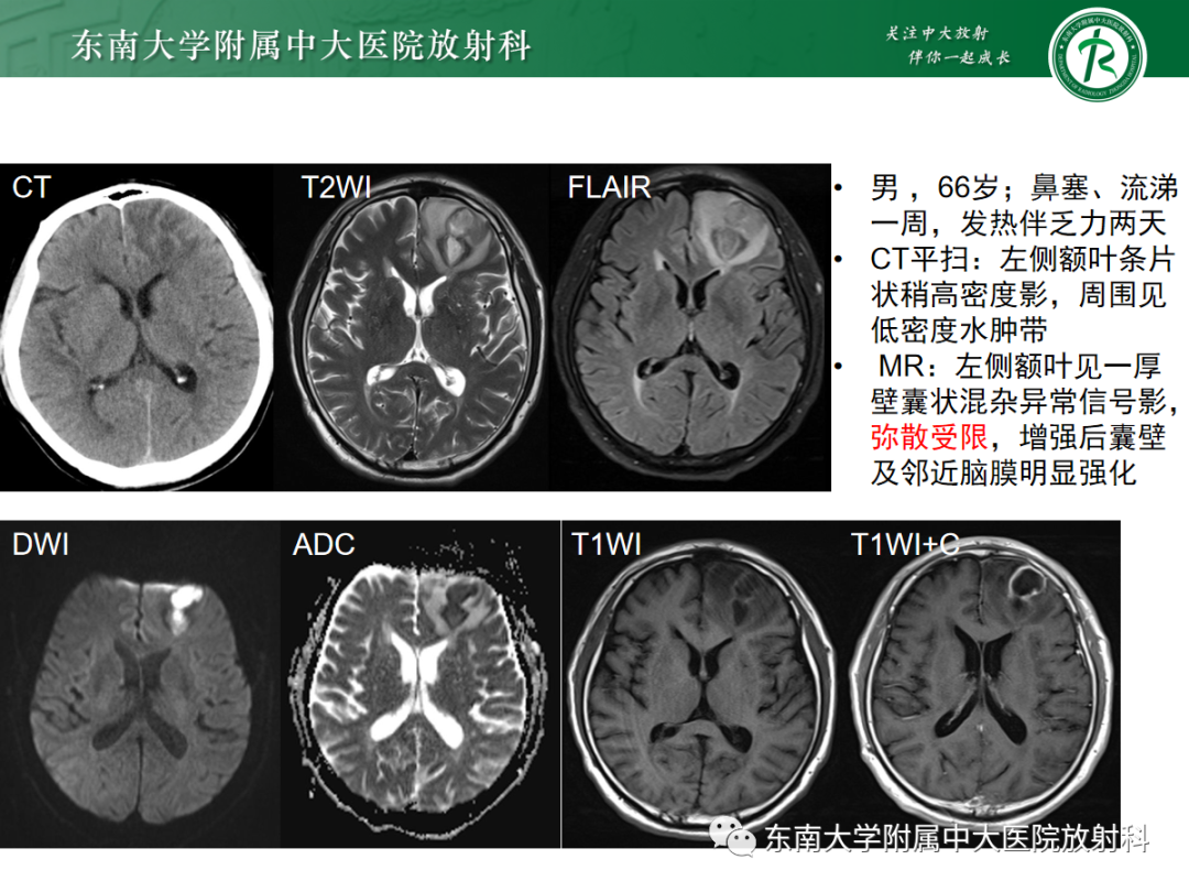 影像PPT - 【PPT】胶质母细胞瘤-35