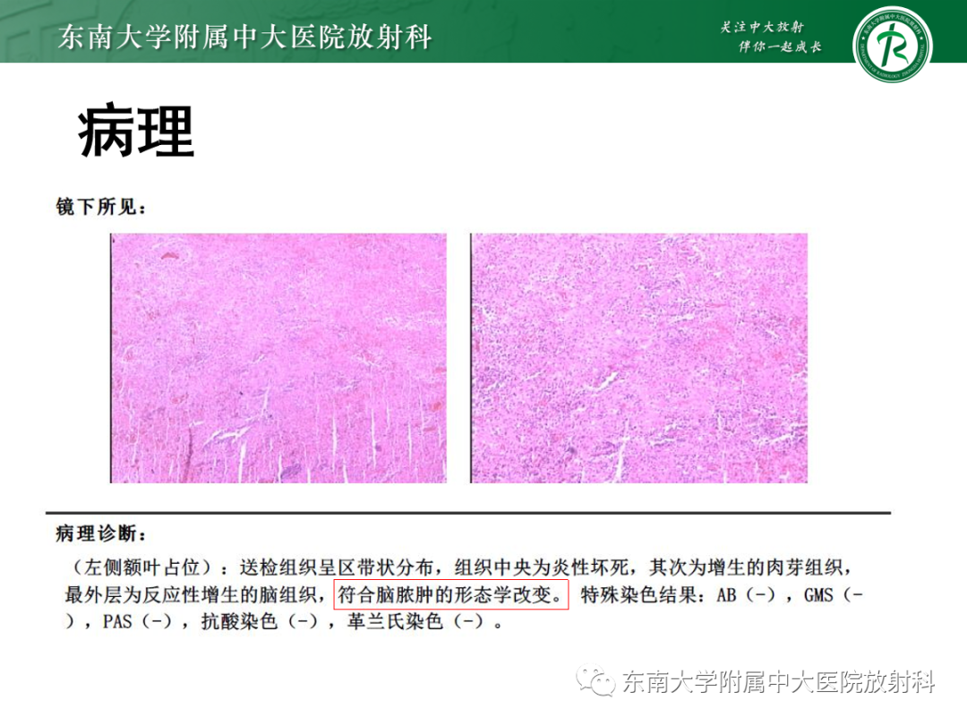 影像PPT - 【PPT】胶质母细胞瘤-36
