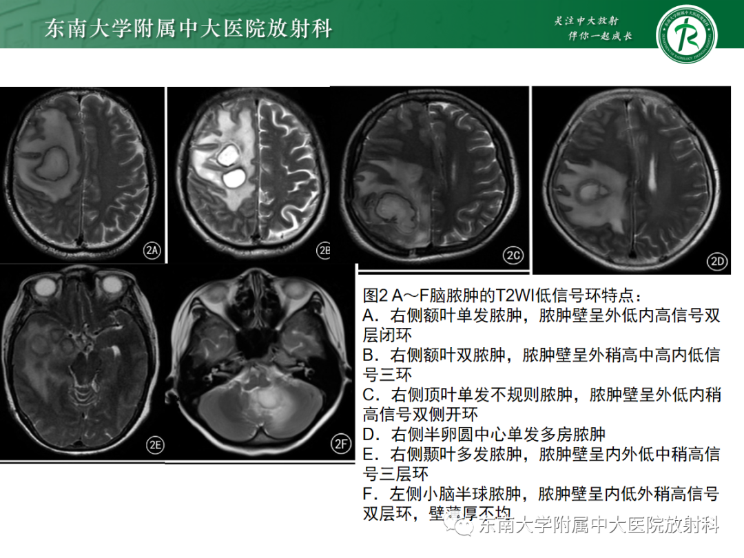 影像PPT - 【PPT】胶质母细胞瘤-37
