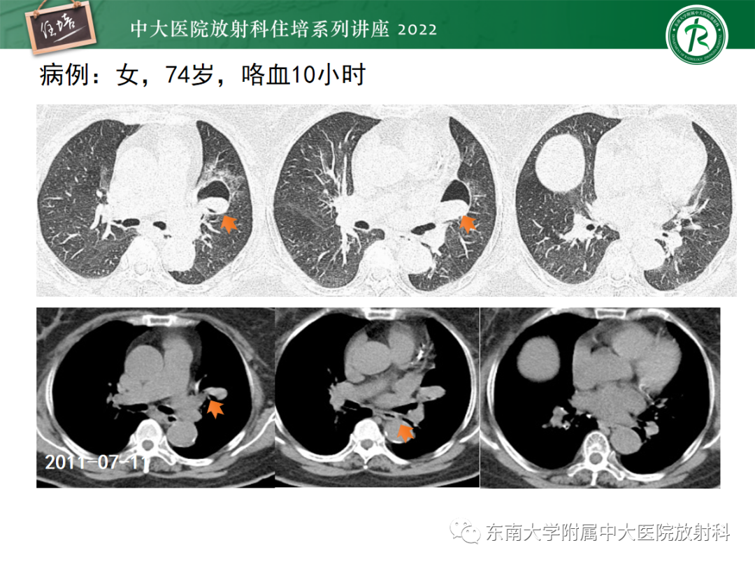 影像PPT - 【PPT】肺空腔、空洞性病变诊断分析思路-3