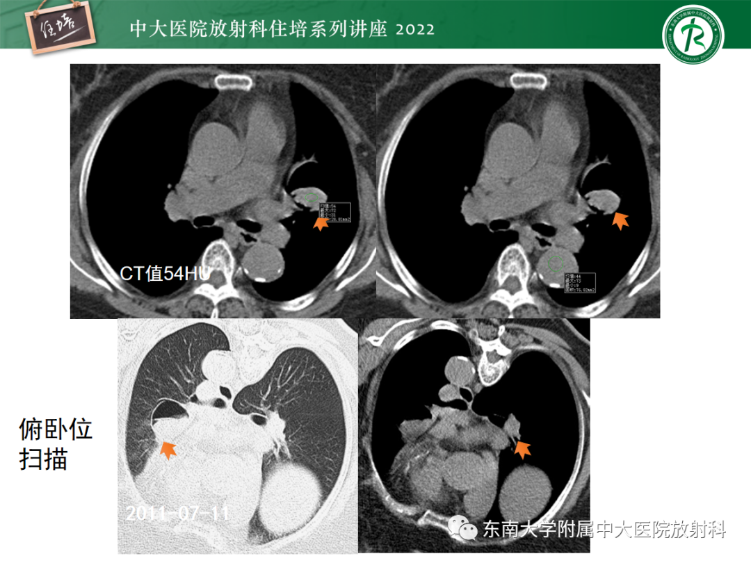 影像PPT - 【PPT】肺空腔、空洞性病变诊断分析思路-4