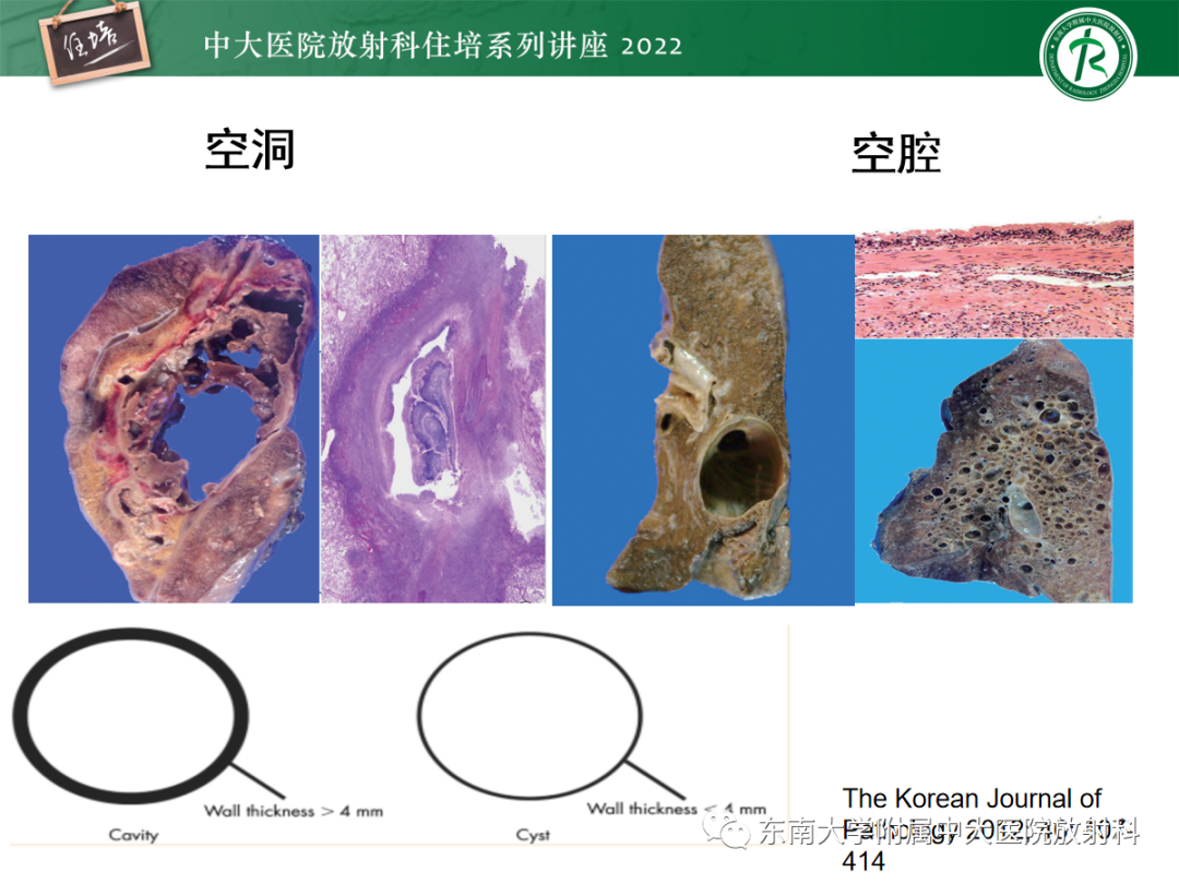 影像PPT - 【PPT】肺空腔、空洞性病变诊断分析思路-7