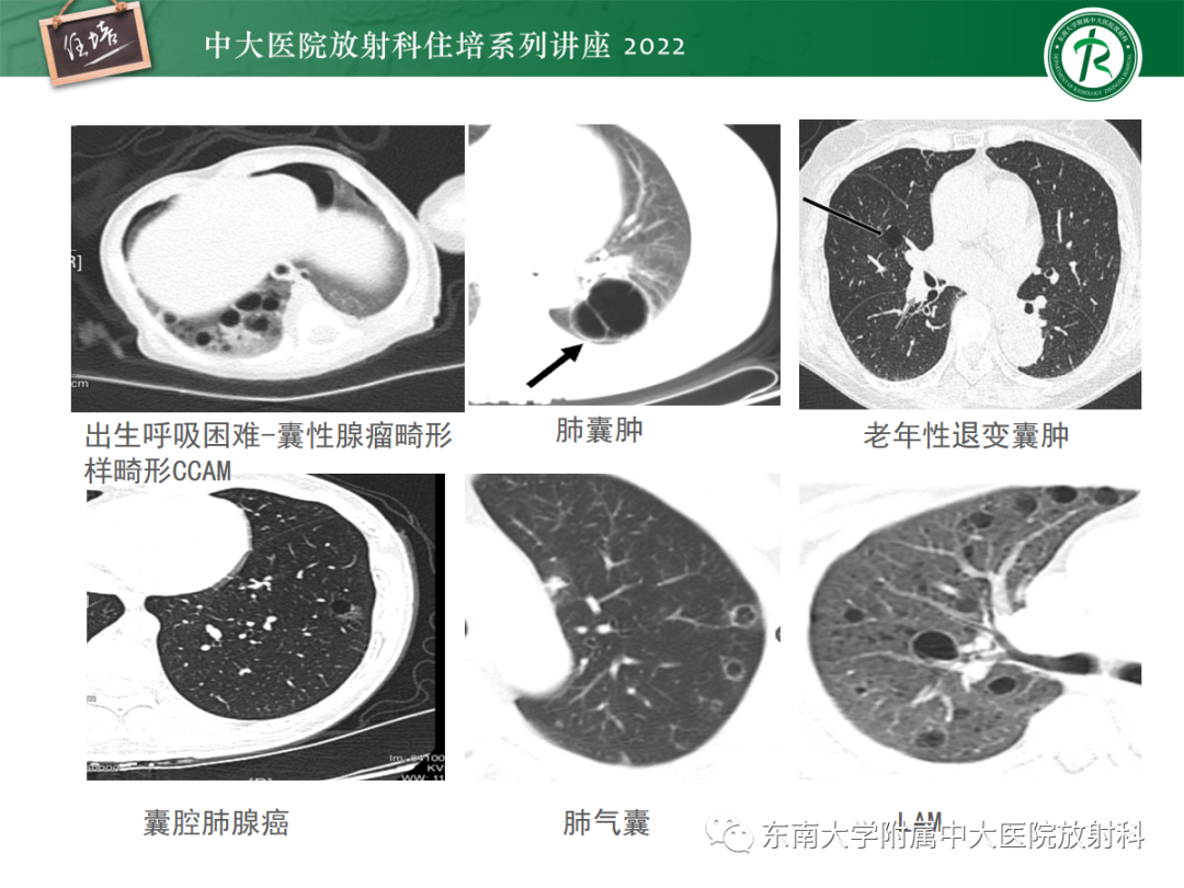 影像PPT - 【PPT】肺空腔、空洞性病变诊断分析思路-11