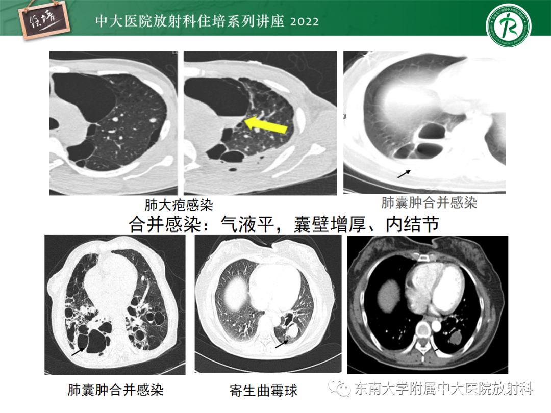 影像PPT - 【PPT】肺空腔、空洞性病变诊断分析思路-12