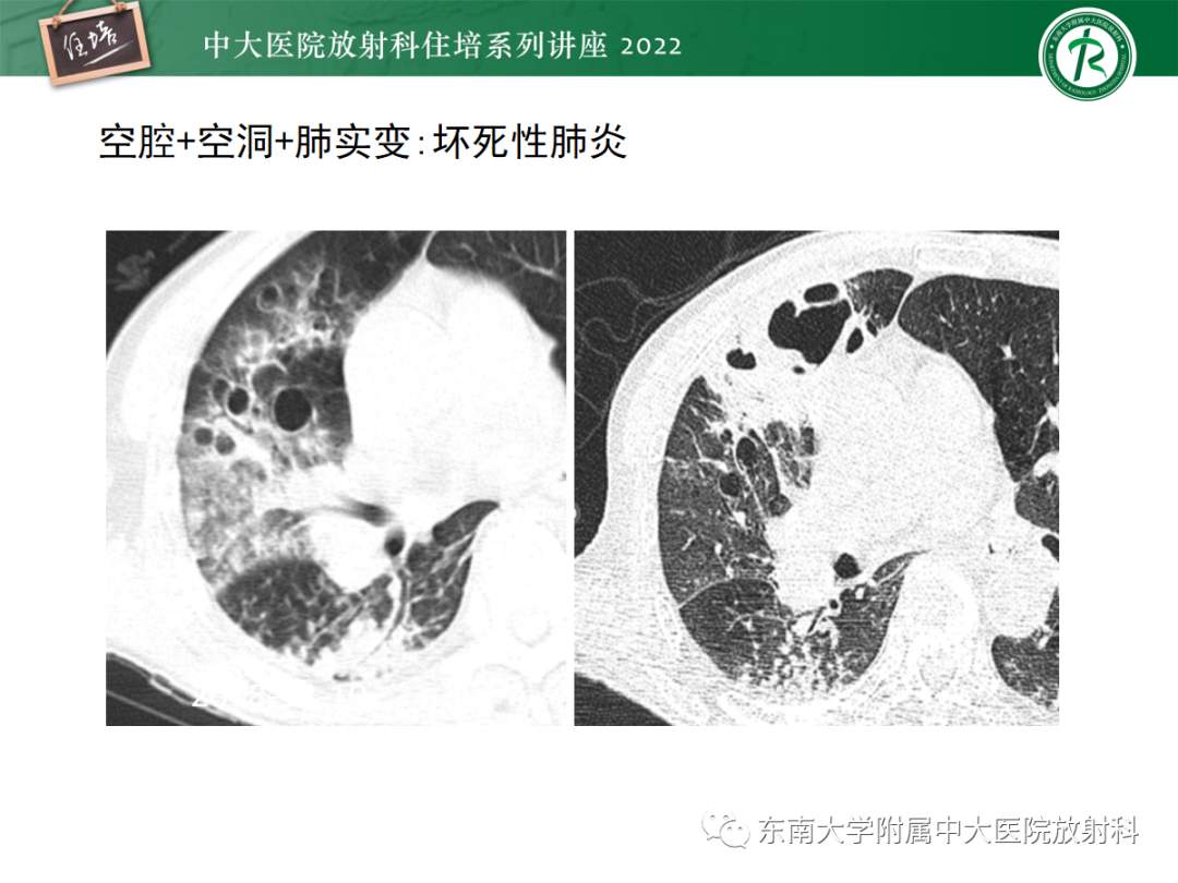 影像PPT - 【PPT】肺空腔、空洞性病变诊断分析思路-13