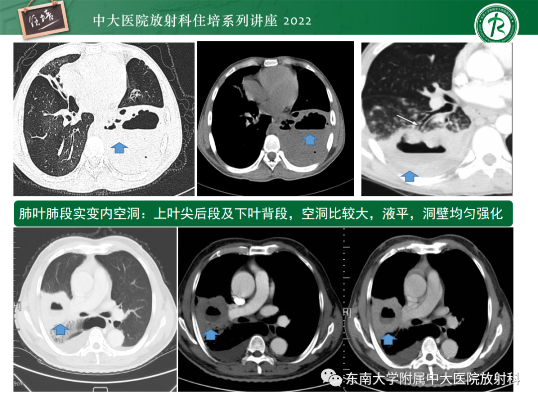影像PPT - 【PPT】肺空腔、空洞性病变诊断分析思路-19