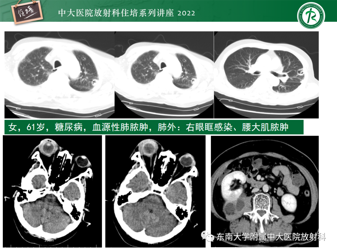 影像PPT - 【PPT】肺空腔、空洞性病变诊断分析思路-20
