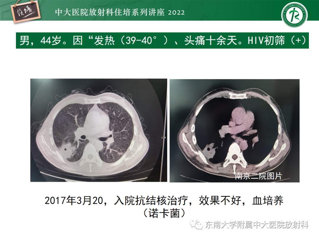 影像PPT - 【PPT】肺空腔、空洞性病变诊断分析思路-21
