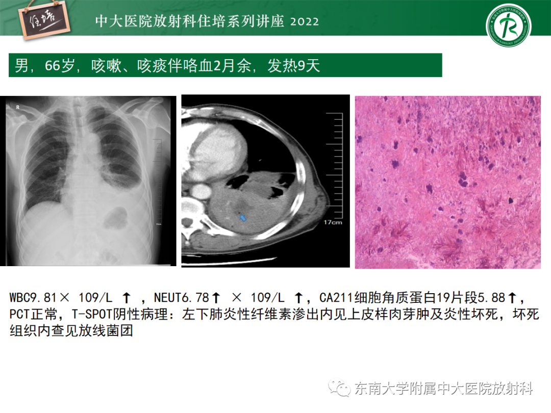 影像PPT - 【PPT】肺空腔、空洞性病变诊断分析思路-22