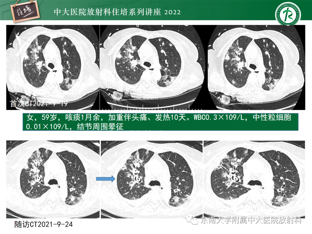 影像PPT - 【PPT】肺空腔、空洞性病变诊断分析思路-24