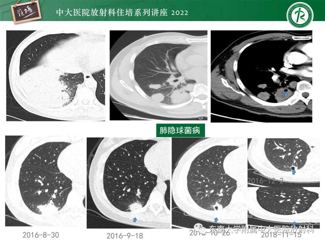 影像PPT - 【PPT】肺空腔、空洞性病变诊断分析思路-25