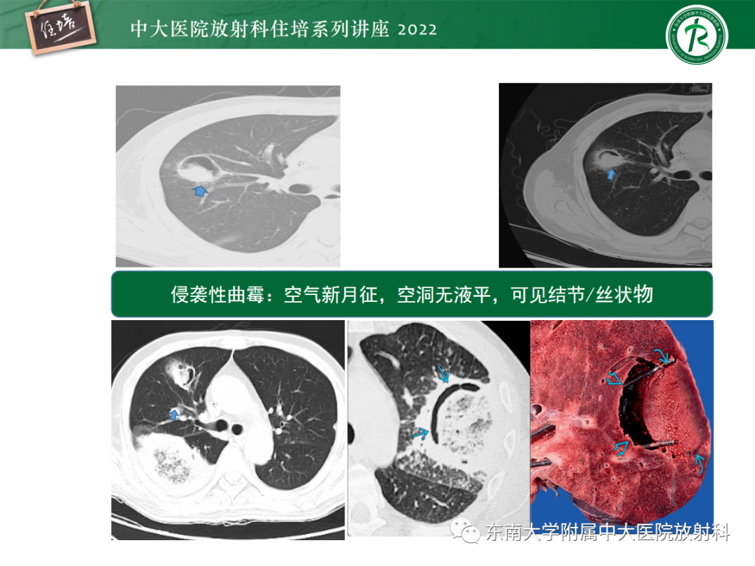 影像PPT - 【PPT】肺空腔、空洞性病变诊断分析思路-23
