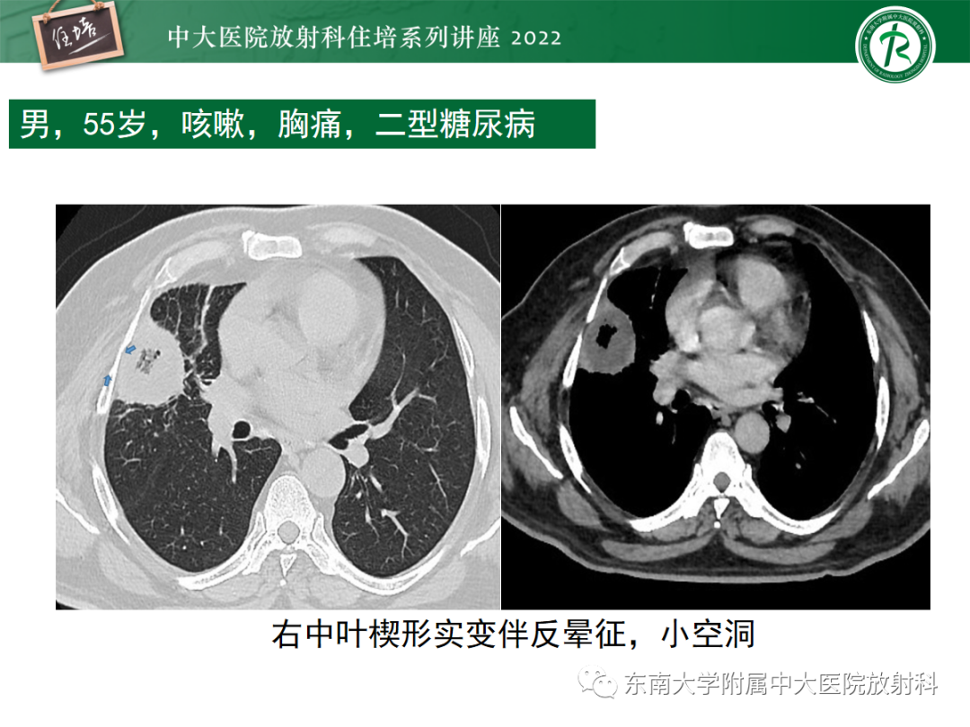 影像PPT - 【PPT】肺空腔、空洞性病变诊断分析思路-29