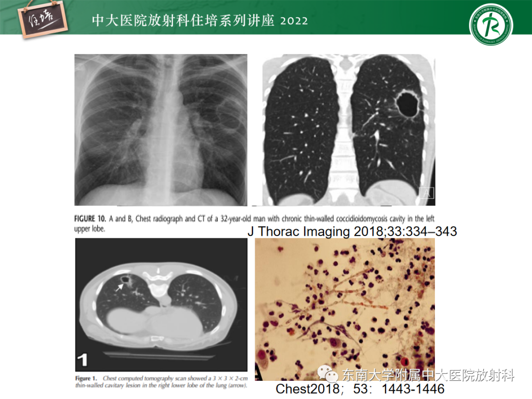 影像PPT - 【PPT】肺空腔、空洞性病变诊断分析思路-31