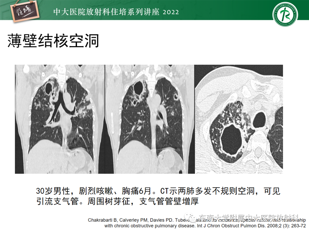 影像PPT - 【PPT】肺空腔、空洞性病变诊断分析思路-35