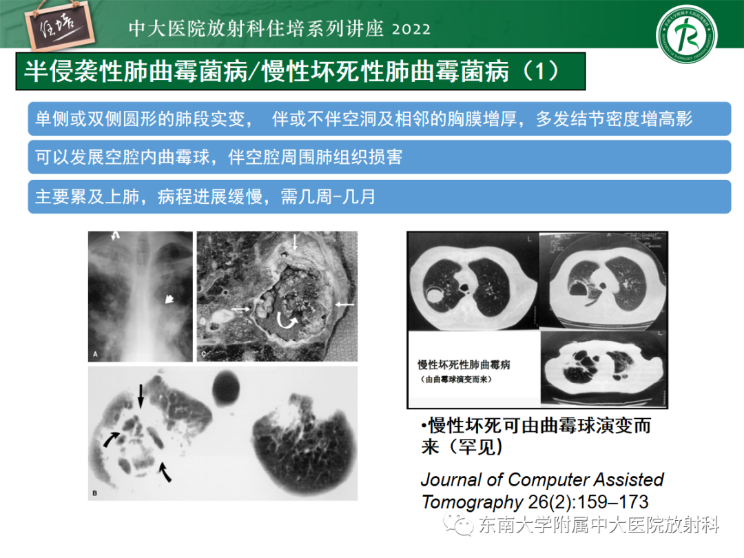 影像PPT - 【PPT】肺空腔、空洞性病变诊断分析思路-38