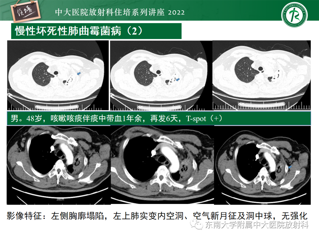 影像PPT - 【PPT】肺空腔、空洞性病变诊断分析思路-39