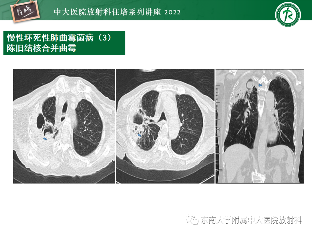 影像PPT - 【PPT】肺空腔、空洞性病变诊断分析思路-40