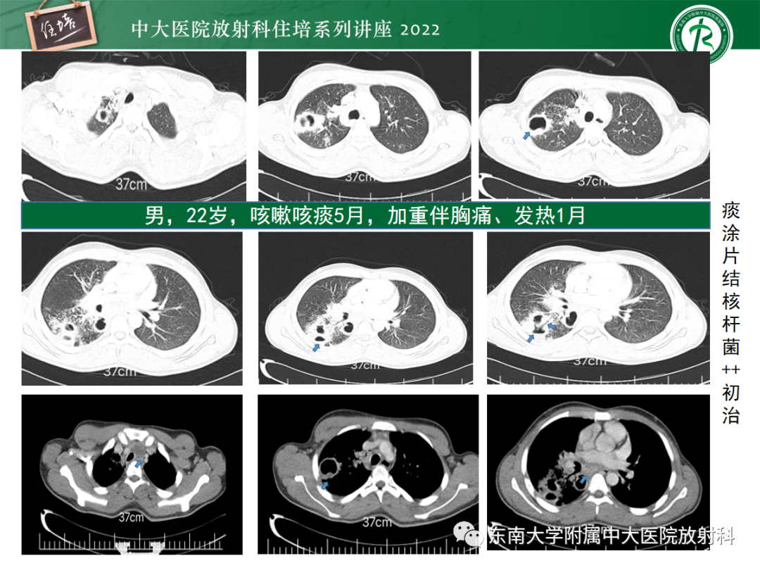影像PPT - 【PPT】肺空腔、空洞性病变诊断分析思路-34