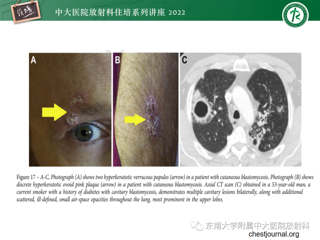 影像PPT - 【PPT】肺空腔、空洞性病变诊断分析思路-42