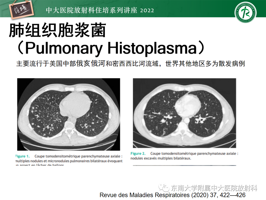 影像PPT - 【PPT】肺空腔、空洞性病变诊断分析思路-43