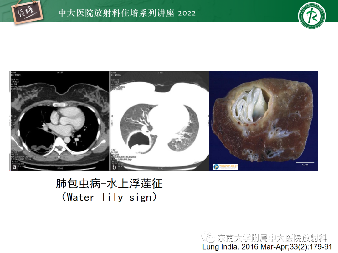 影像PPT - 【PPT】肺空腔、空洞性病变诊断分析思路-46